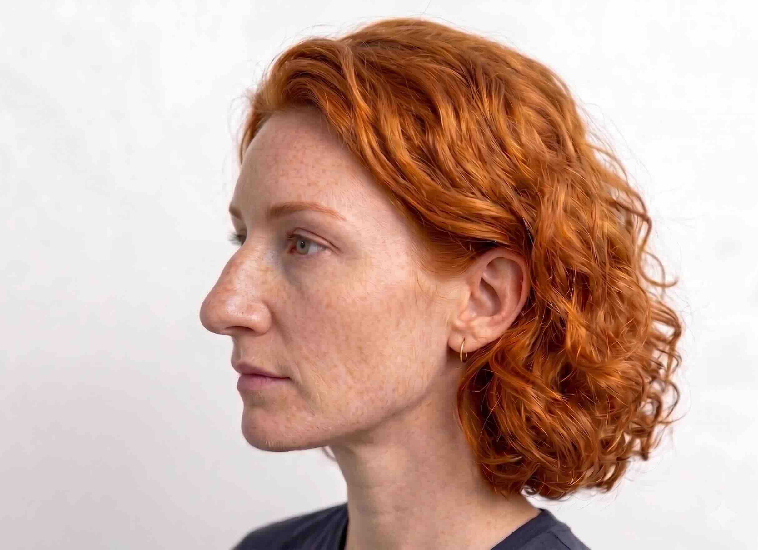 Après — rhinoplastie homme